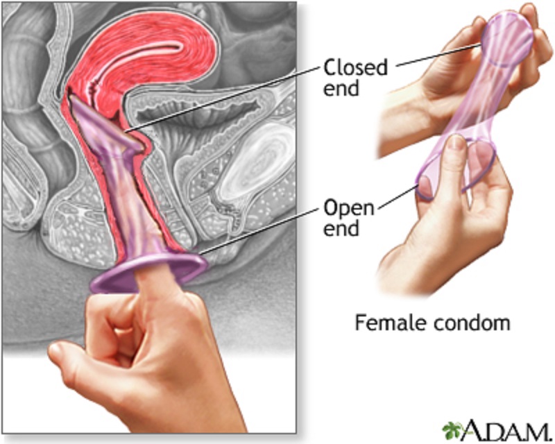 Female condoms