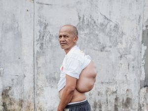 back tumour 001 006041