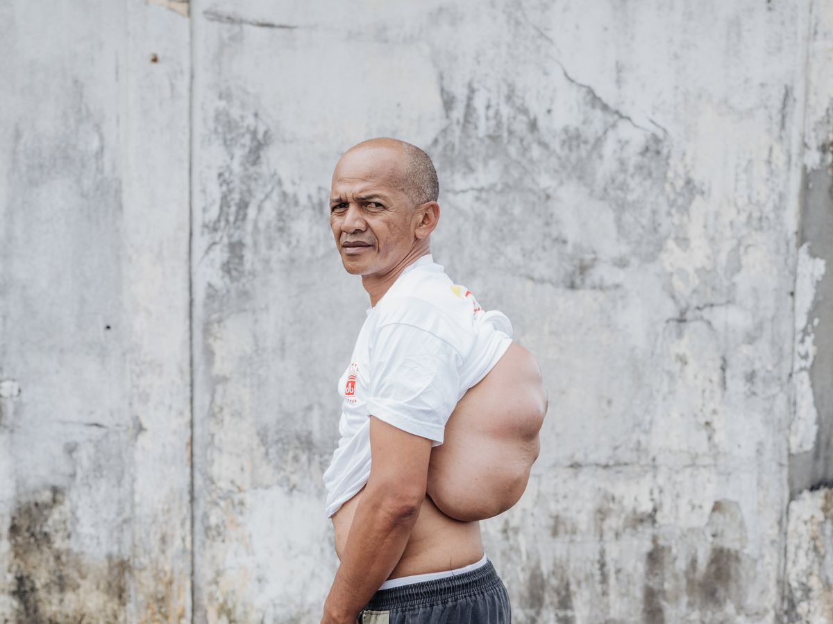 back tumour 001 006041