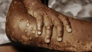 A patient with Monkeypox