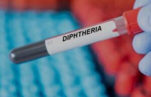 Diphtheria
