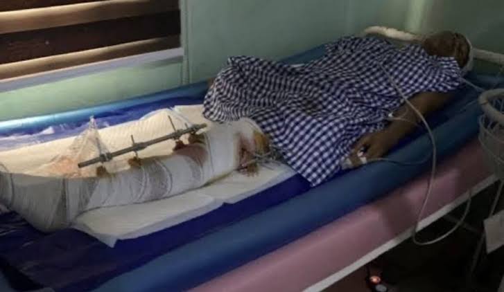 Phyna’s sister, Ruth who was hit by Dangote truck is dead 2 Ruth Otabor lying in the hospital bed after the tragic truck accident that left one of her legs amputated