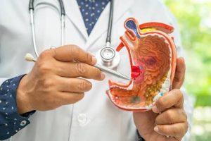 Stomach cancer