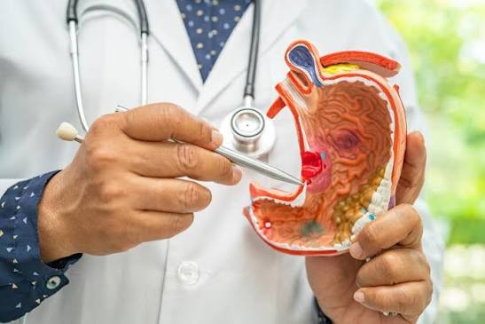 Stomach cancer