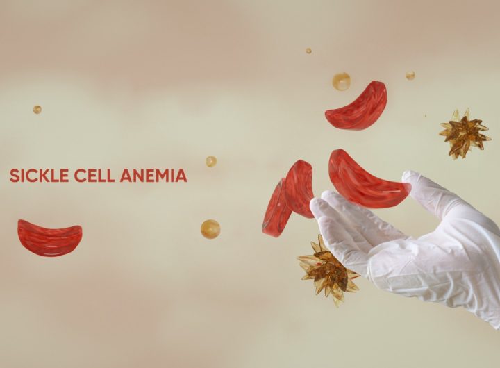 Nigeria accounts for over 1.5 million children with sickle cell disease, highest in the world – New Lancet study shows